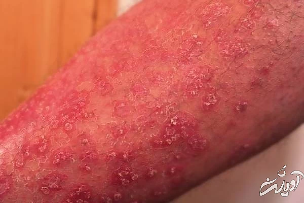 عوارض عرق سوز شدن